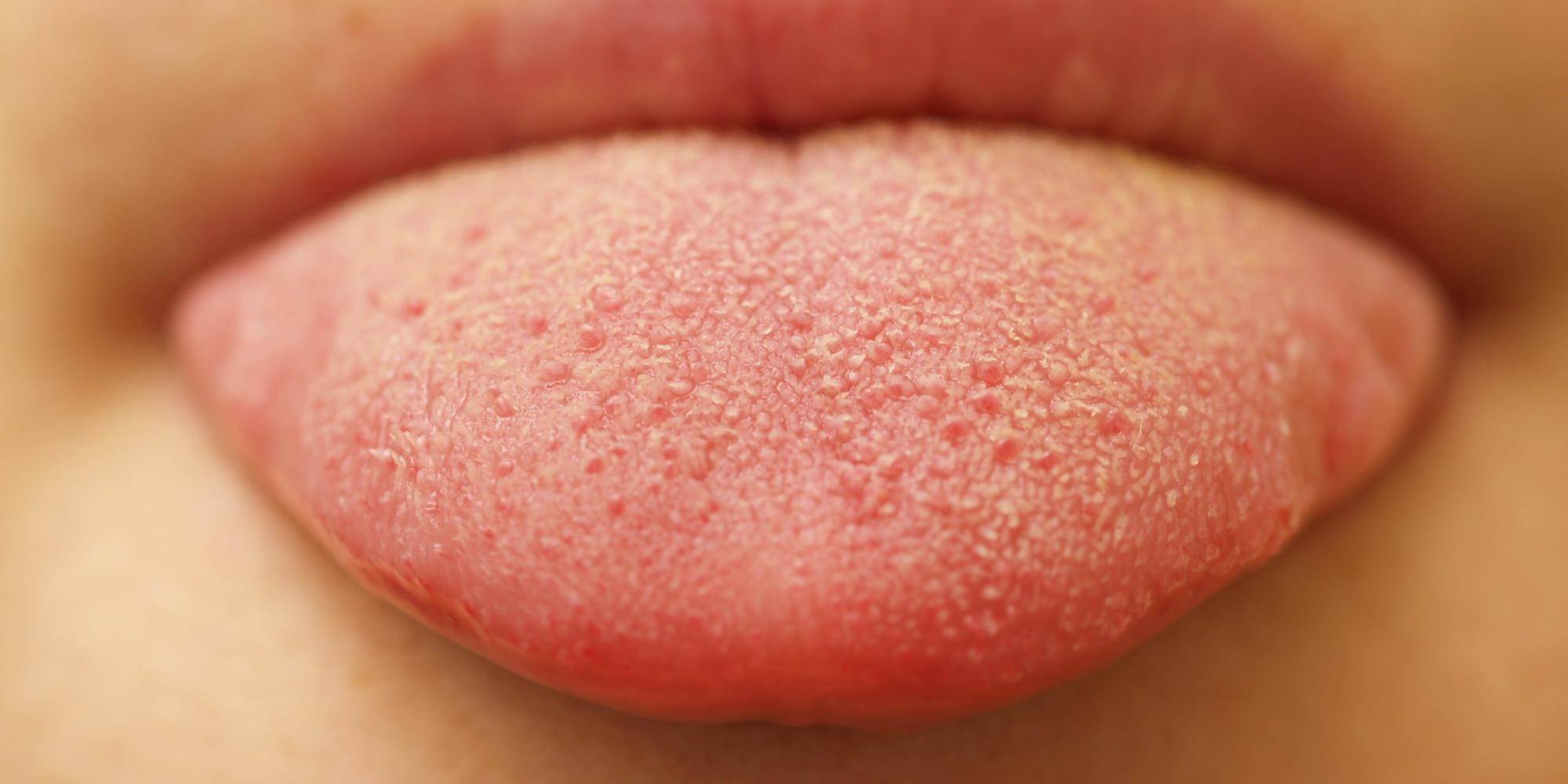 عفونت قارچی دهان (برفک دهان) بر اثر چه عواملی بوجود می‌آید؟