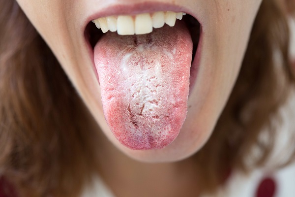 درمان برفک دهان