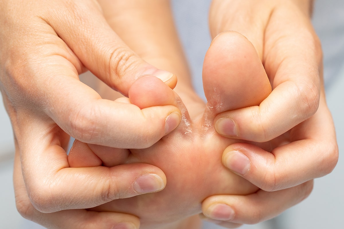 اصلی ترین علائم و دلایل ایجاد عفونت قارچ انگشتان پا