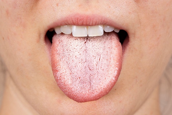 نکات مهم درمان برفک دهان
