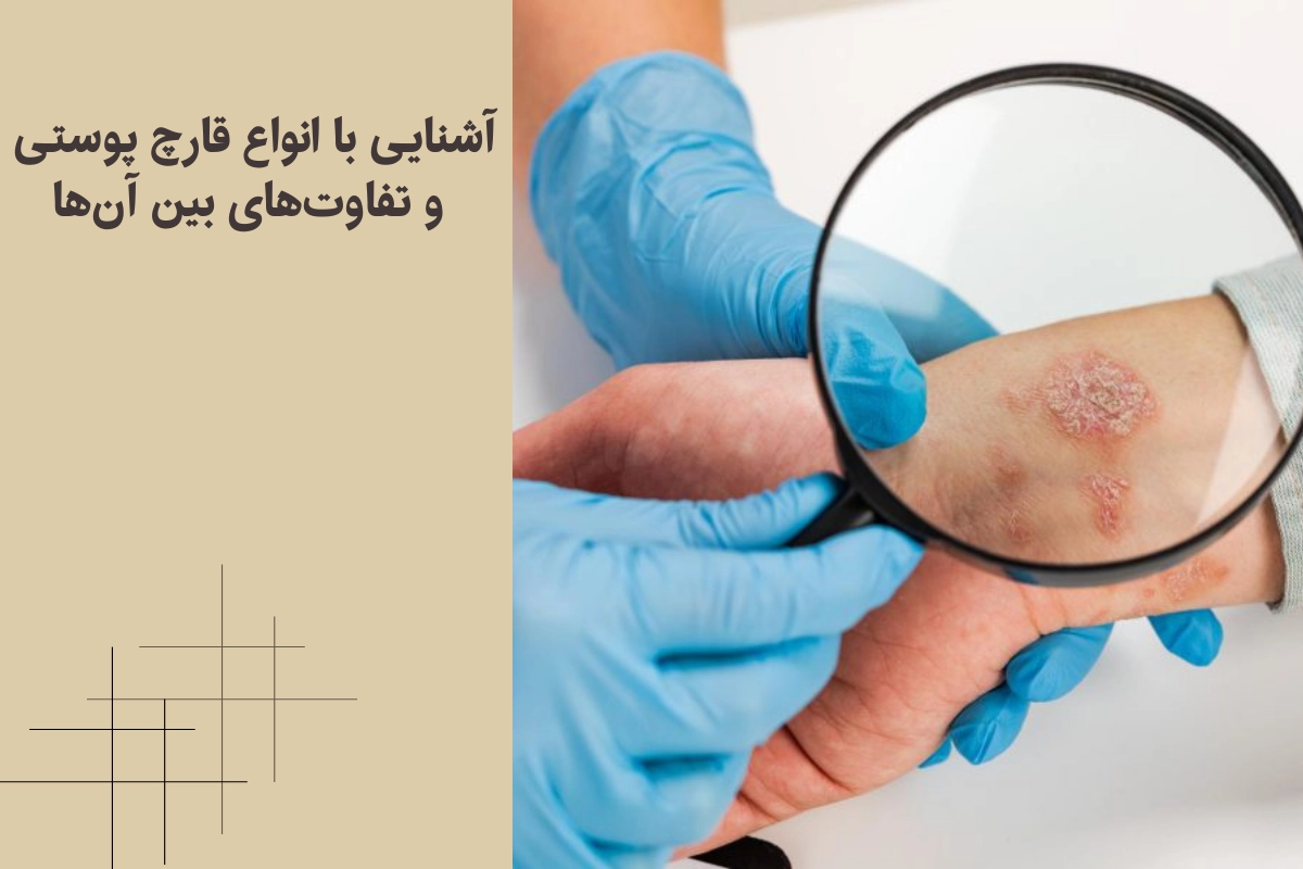 آشنایی با انواع قارچ پوستی و تفاوتهای بین آنها
