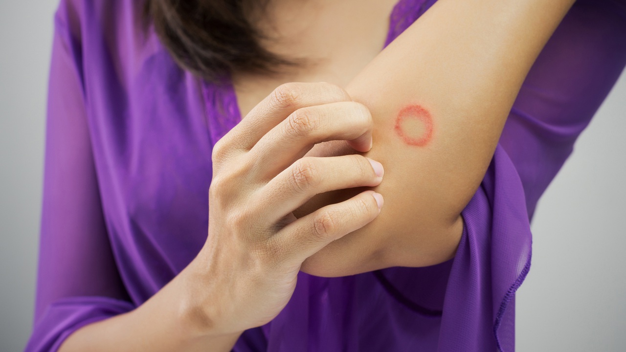 بیماری عفونی کرم حلقوی پوست چگونه ایجاد می‌شود؟