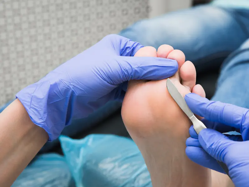 علائم قارچ تینه‌آ ورسیکالر (پیتریازیس رنگارنگ)