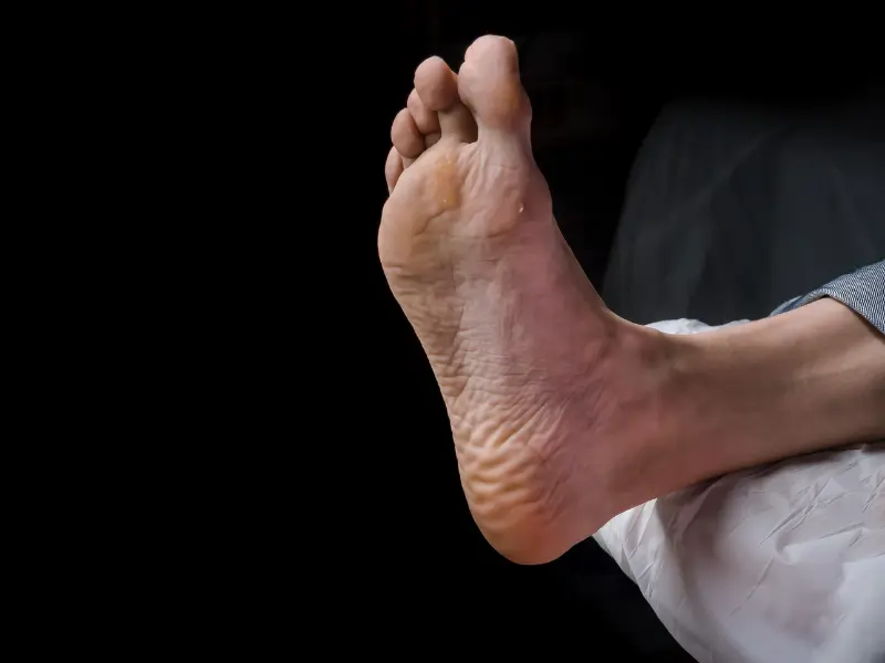 درمان انواع قارچ پوستی ساده است!