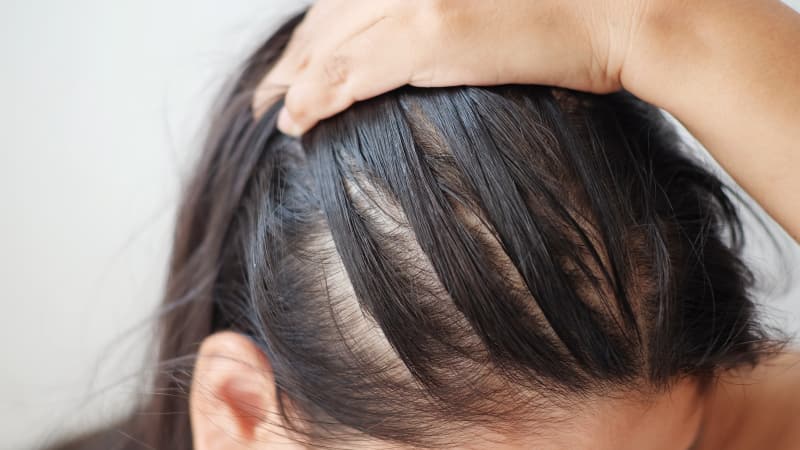 انواع ریزش مو : معرفی 9 نوع مهم ریزش مو + دلایل و راهکارهای پیشگیری