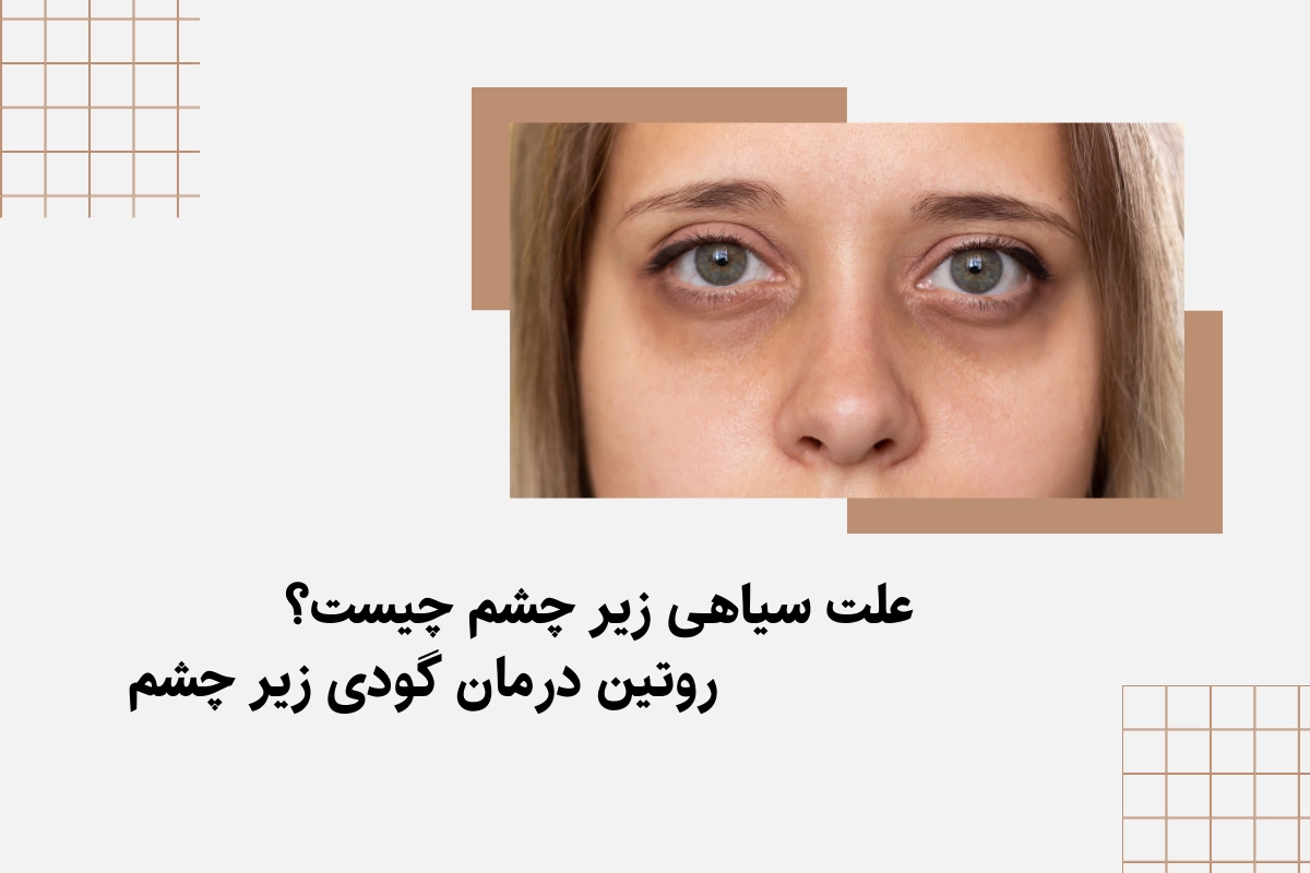 علت سیاهی زیر چشم چیست؟ / روتین درمان گودی زیر چشم