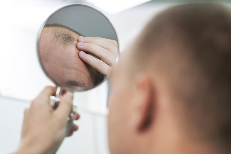 4 علت اصلی ریزش مو در مردان + راهکار ویژه رفع آن