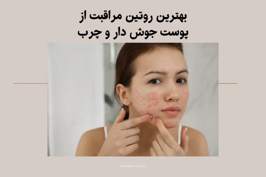بهترین روتین مراقبت از پوست جوش دار و چرب