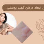 دلایل ایجاد درمان کهیر پوستی + بهترین روش درمان جای کهیر