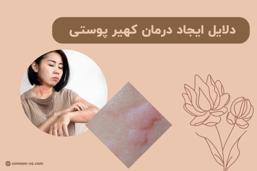 دلایل ایجاد درمان کهیر پوستی + بهترین روش درمان جای کهیر