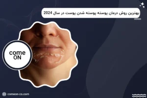 بهترین روش درمان پوسته پوسته شدن پوست در سال 2024