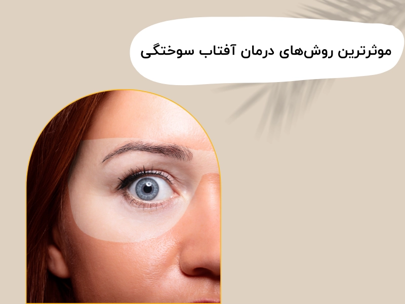 موثرترین روش‌های درمان آفتاب سوختگی