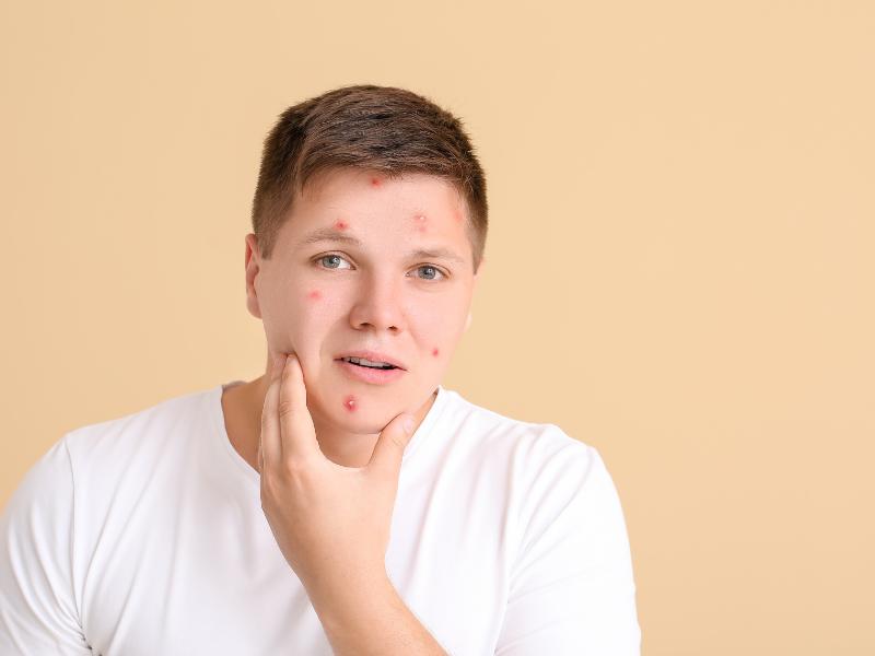 دلایل ایجاد جوش زیر پوستی