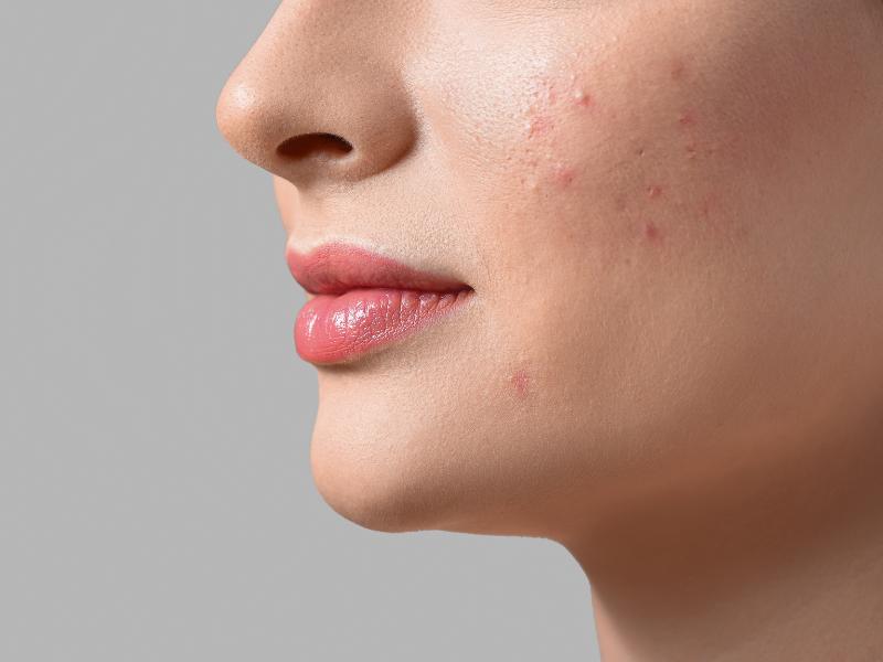 جوش سفت زیر پوستی