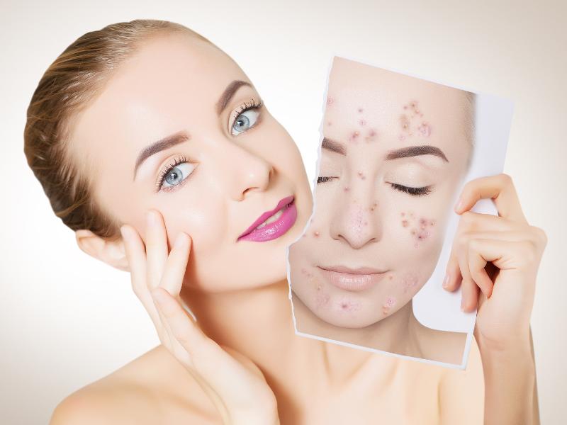 درمان جوش زیر پوستی صورت