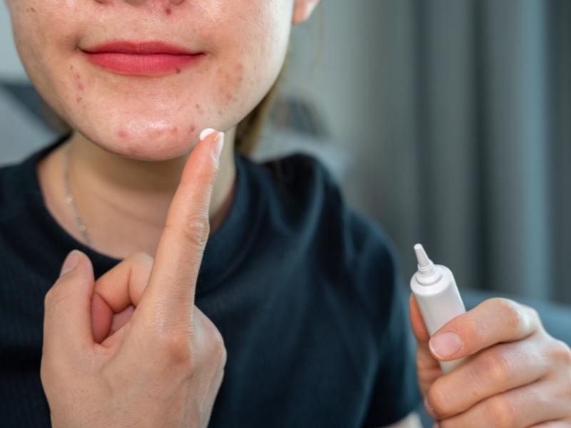 پمادهای مناسب برای درمان جوش زیر پوستی