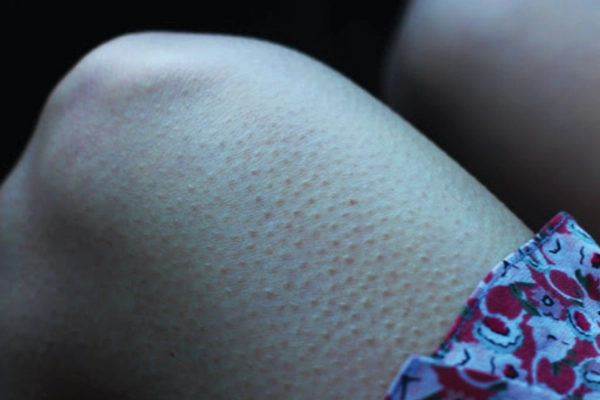 درمان پوست مرغی