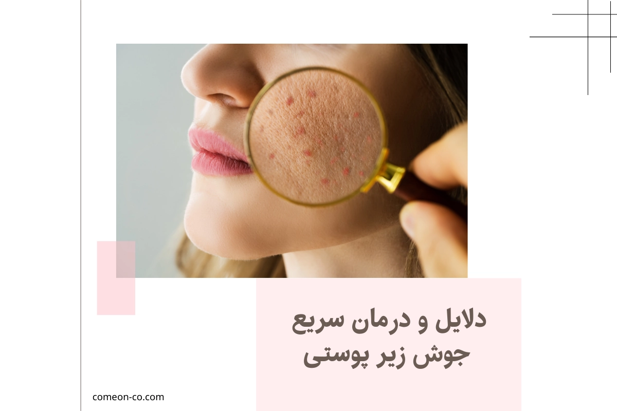 دلایل و درمان سریع جوش زیر پوستی