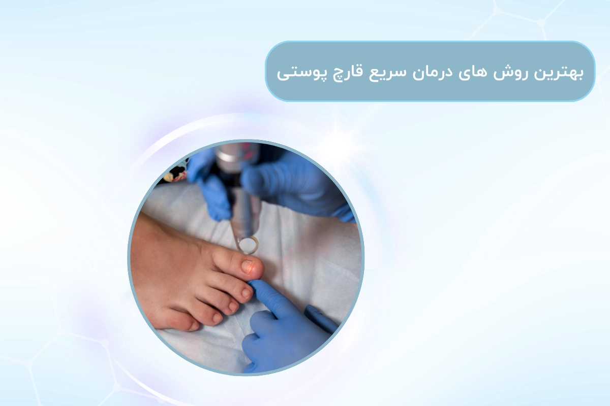 بهترین روش های درمان سریع قارچ پوستی + علت و علائم