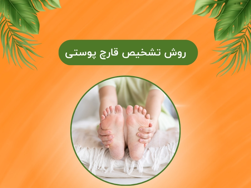 روش تشخیص قارچ پوستی