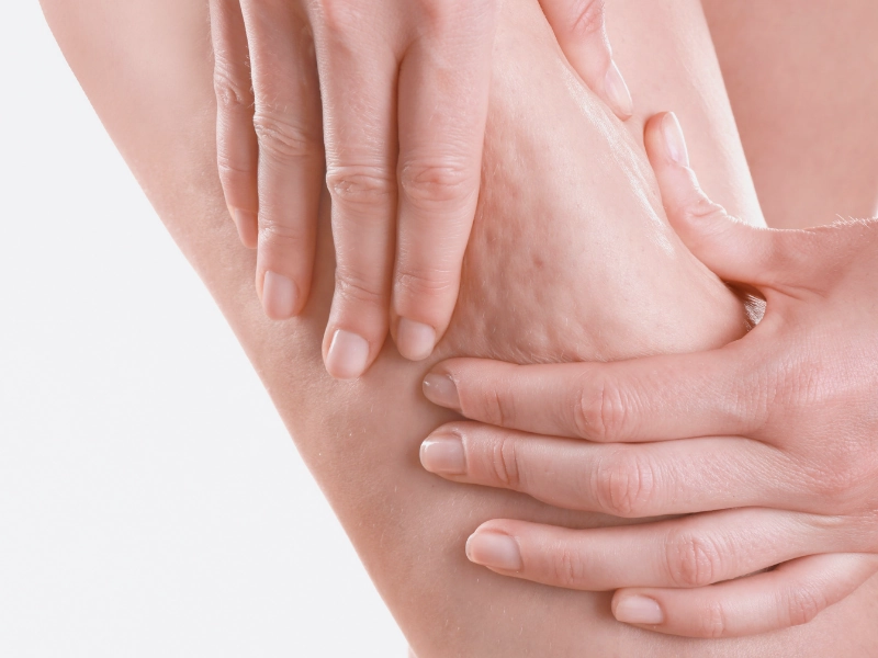 علت به وجود آمدن سلولیت