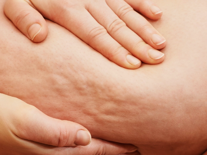 راههای درمان سلولیت