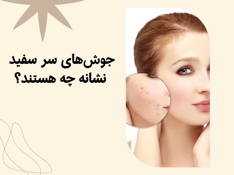 جوشهای سر سفید نشانه چه هستند