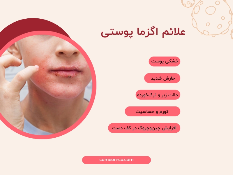 علائم اگزما پوستی