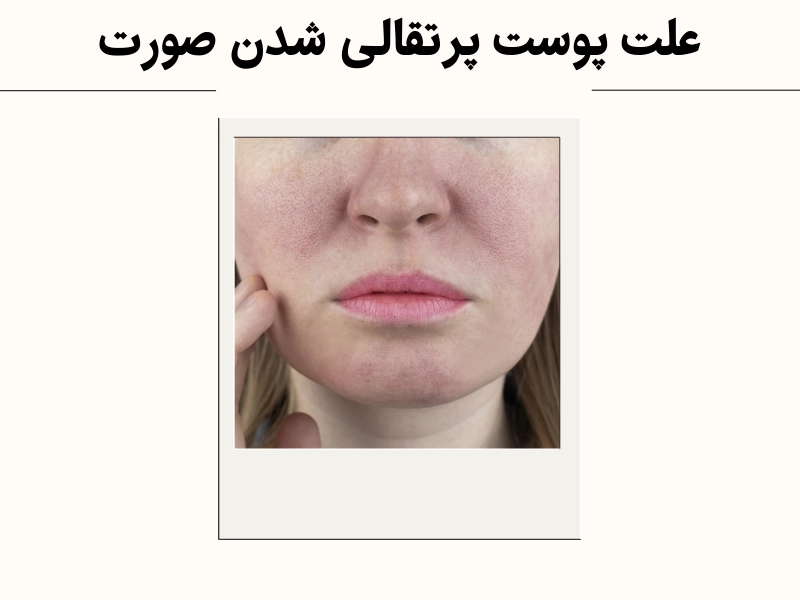 علت پوست پرتقالی شدن صورت