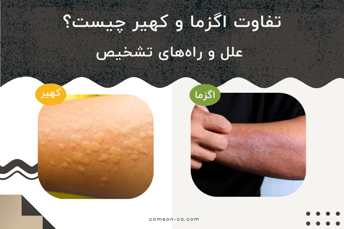 تفاوت اگزما و کهیر چیست؟ + علل و راههای تشخیص
