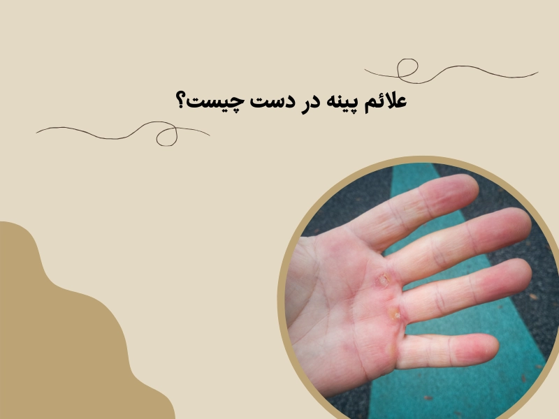 علائم پینه در دست چیست؟