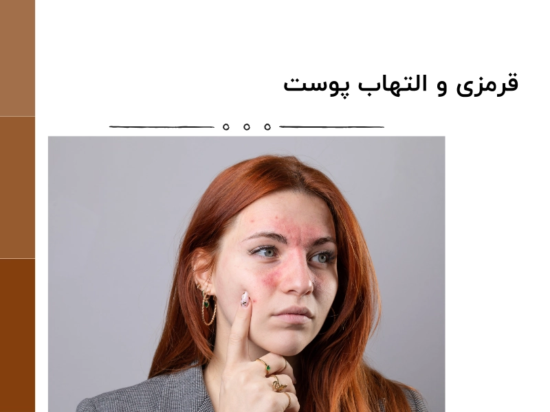 قرمزی و التهاب پوست