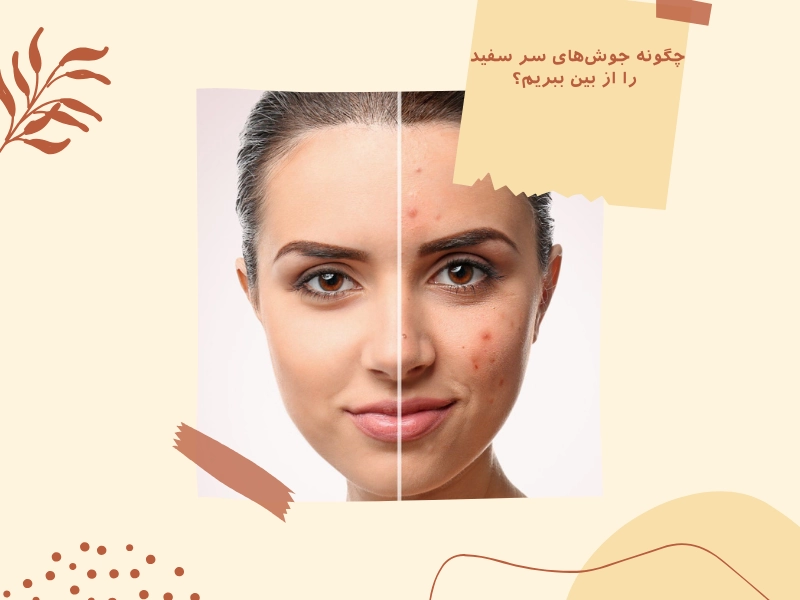 چگونه جوشهای سر سفید را از بین ببریم؟
