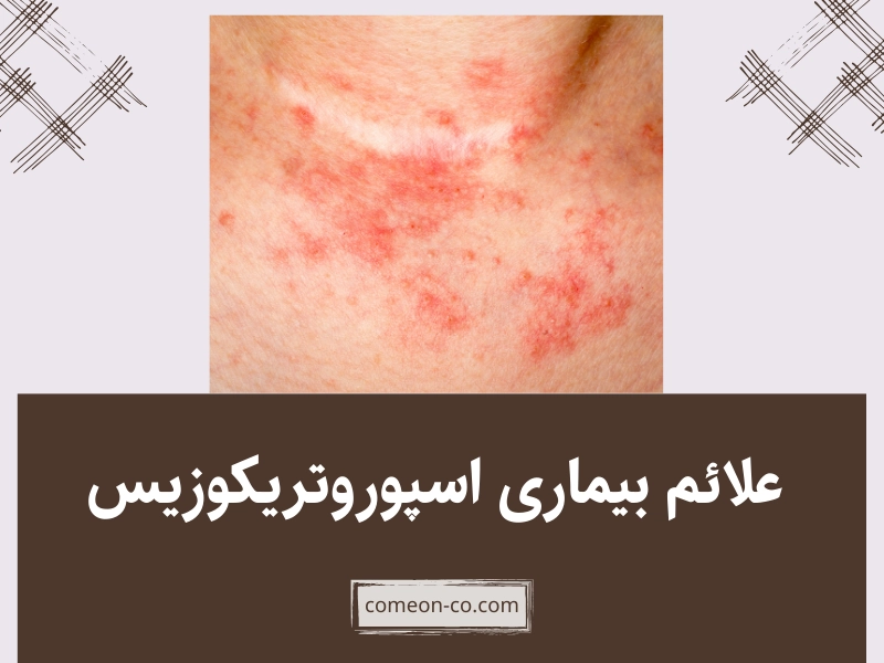 علائم بیماری اسپوروتریکوزیس