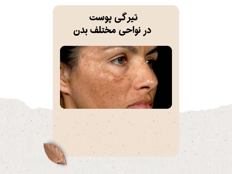 تیرگی پوست در نواحی مختلف بدن