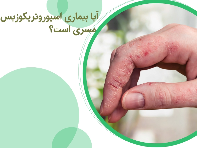 آیا بیماری اسپوروتریکوزیس مسری است؟
