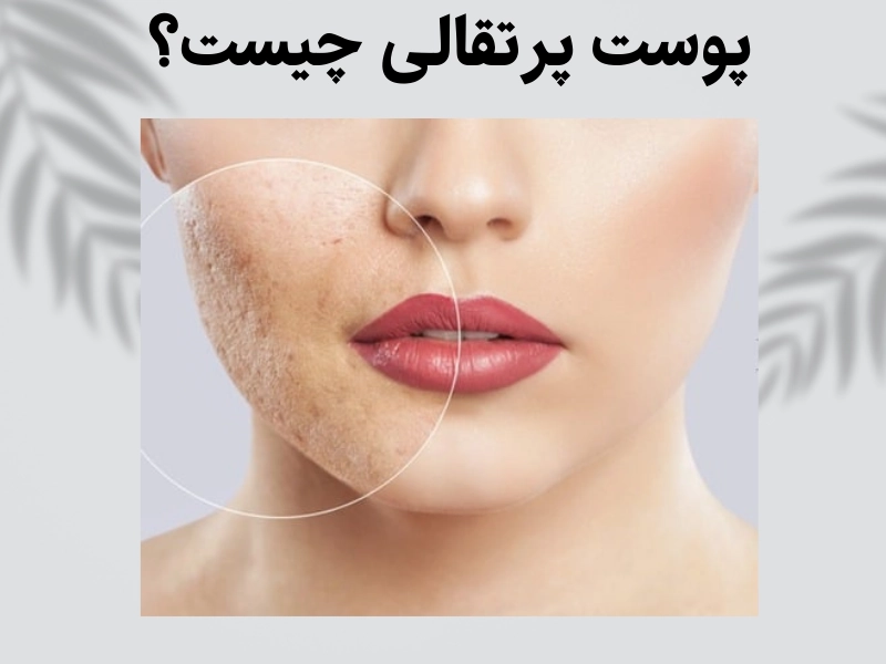 پوست پرتقالی چیست