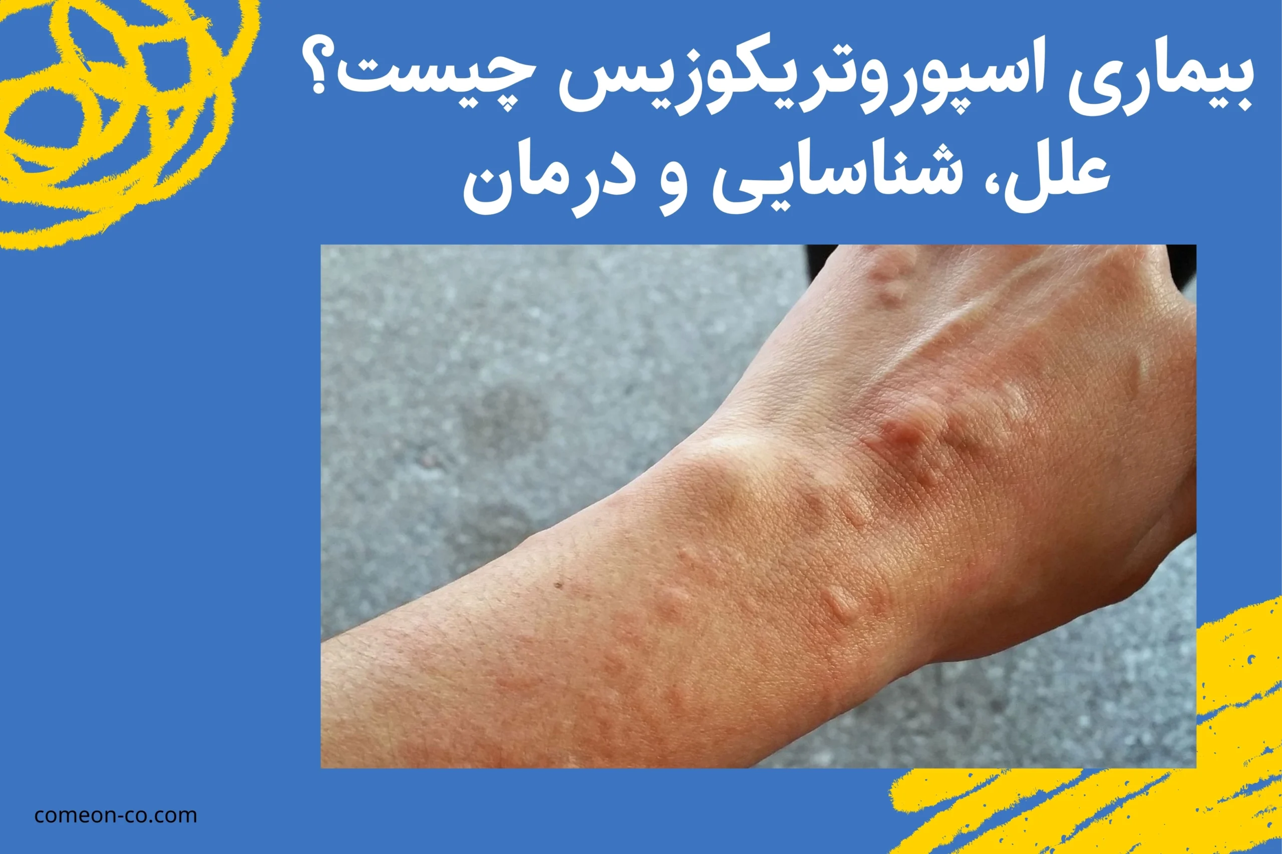 بیماری اسپوروتریکوزیس چیست