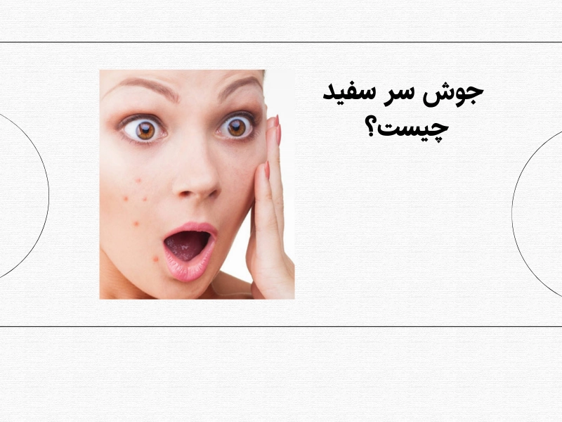 جوش سر سفید چیست