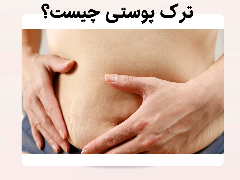 ترک پوستی چیست