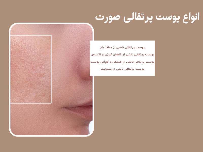 انواع پوست پرتقالی صورت