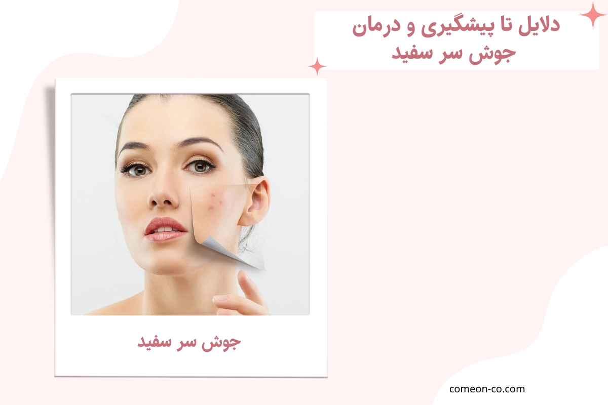 جوش سر سفید
