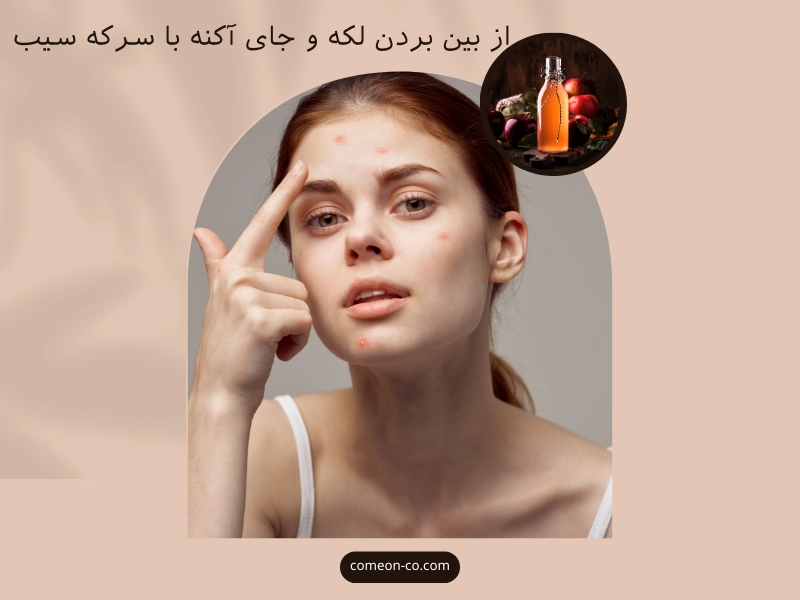 از بین بردن لکه و جای آکنه با سرکه سیب و سایر جایگزینها