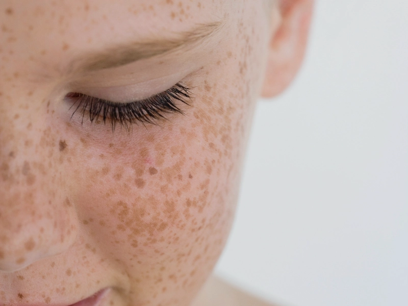 لک صورت نشانه چیست؟