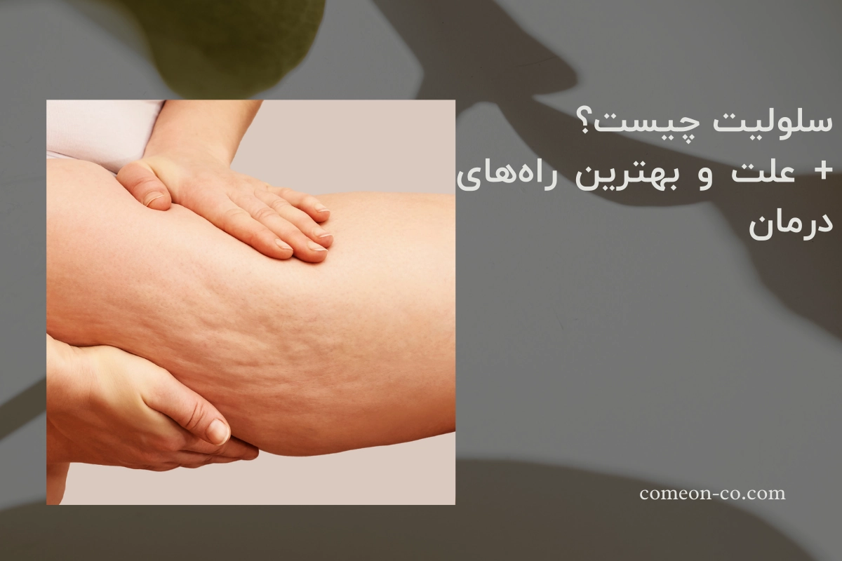 سلولیت چیست؟ + علت و بهترین راههای درمان