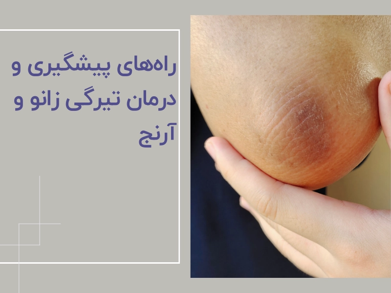 راه‌های پیشگیری و درمان تیرگی زانو و آرنج