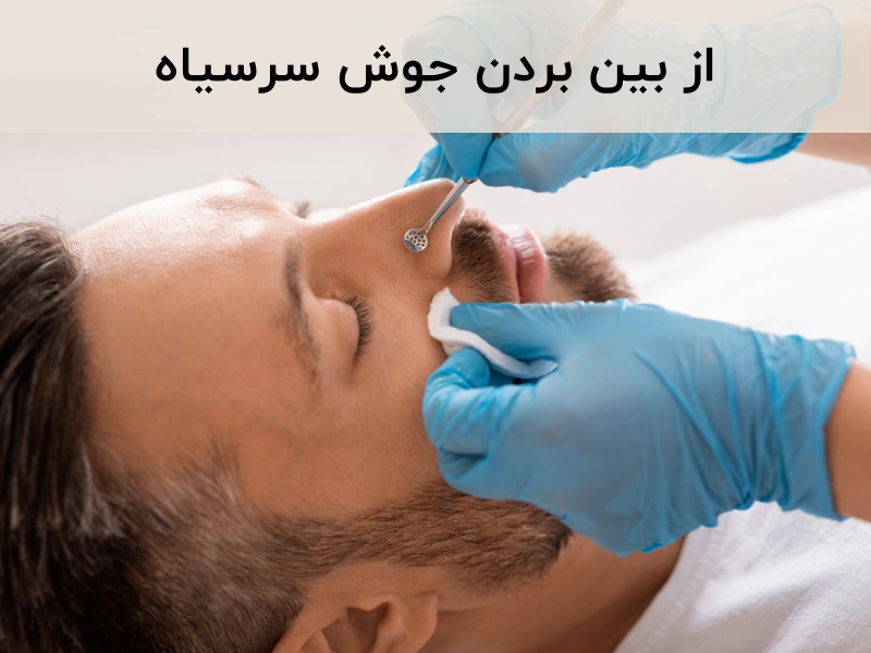 از بین بردن جوش سرسیاه