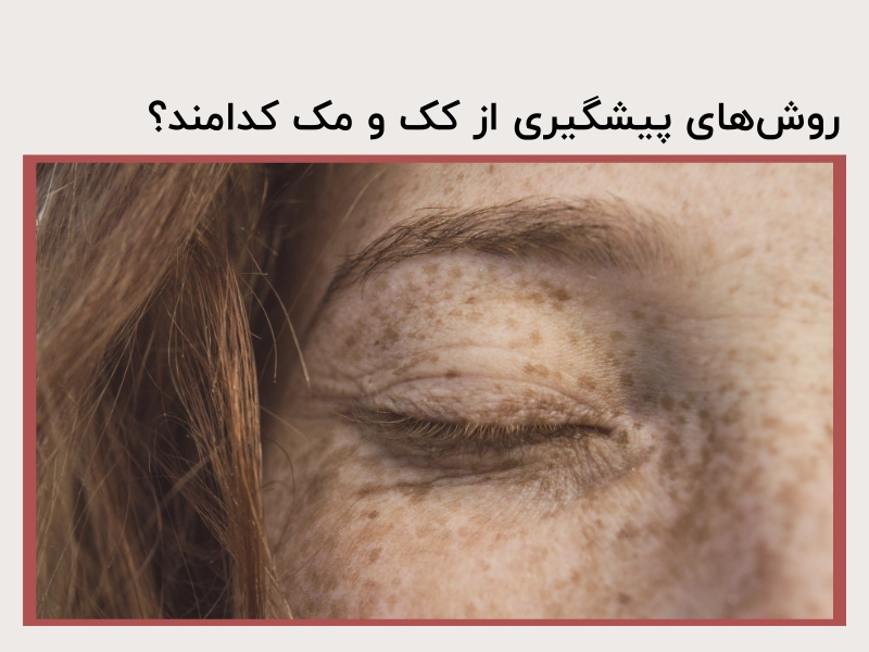روشهای پیشگیری از کک و مک کدامند؟