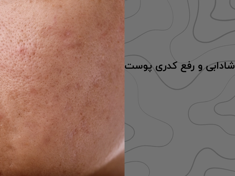 شادابی و رفع کدری پوست