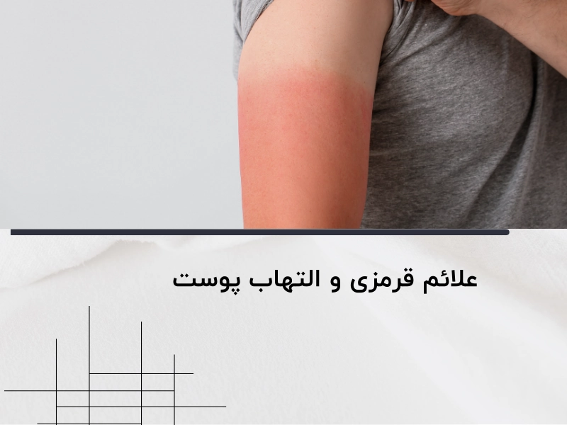 علائم قرمزی و التهاب پوست